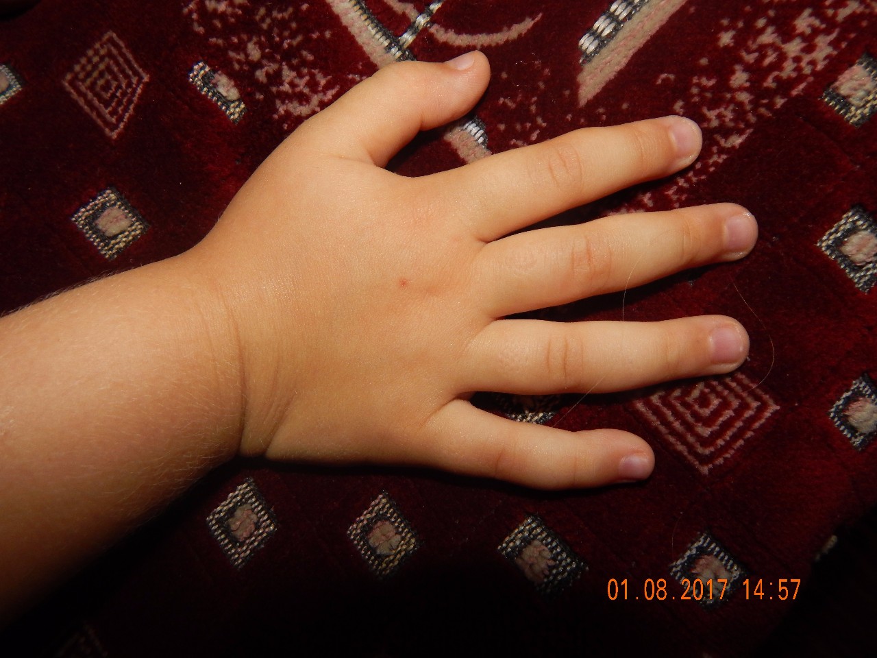 Гемангиома на Пальчике руки