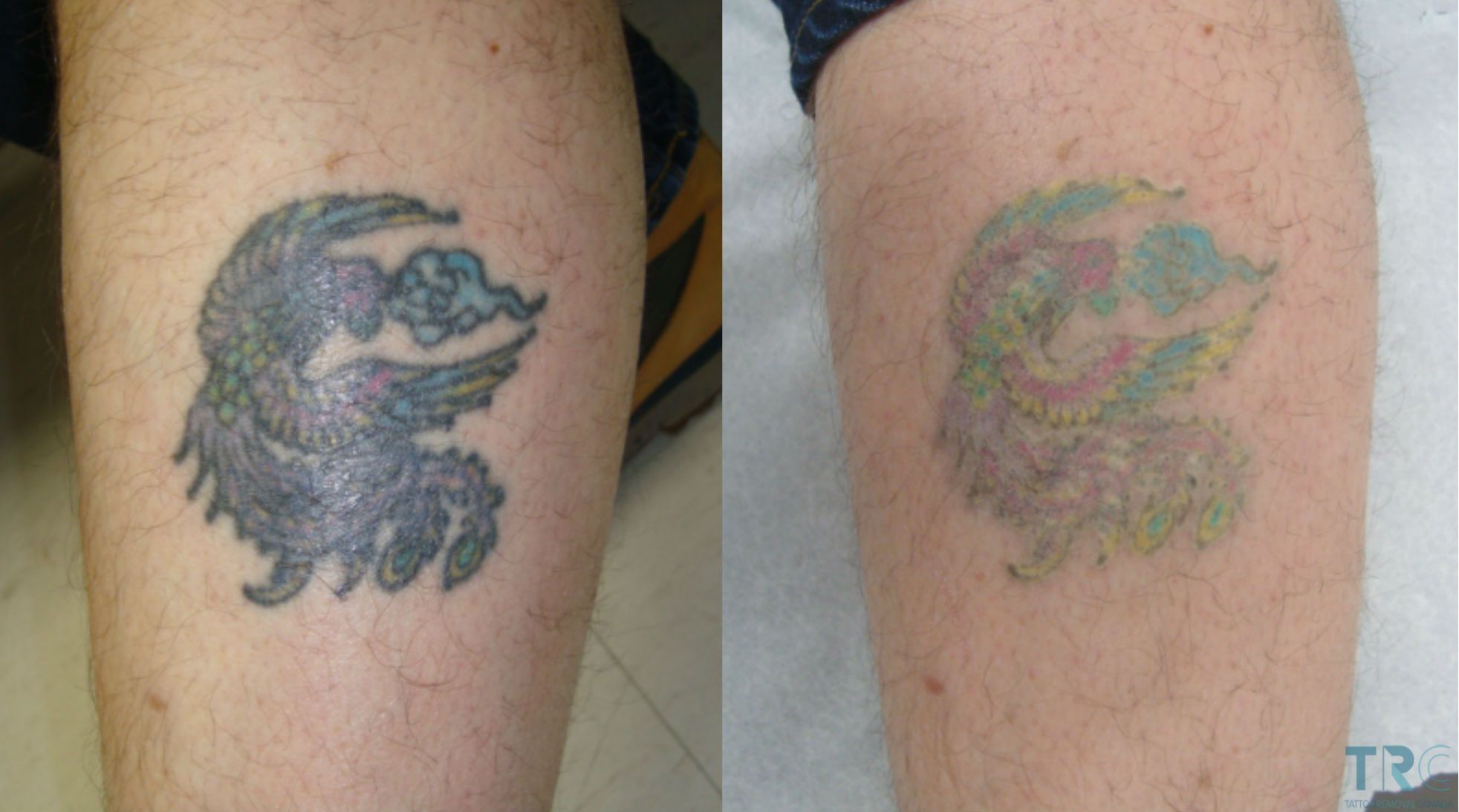Лазерное удаление тату до и после
