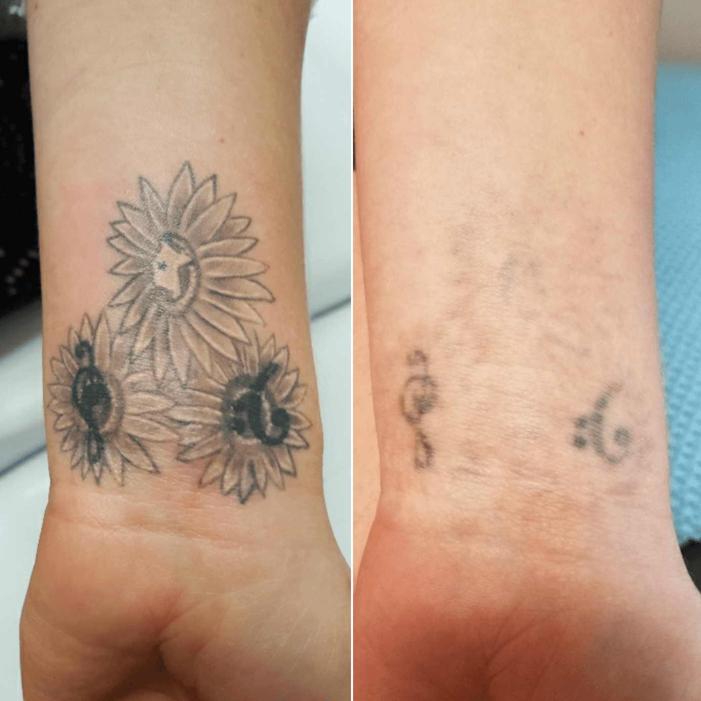 кожа после удаления тату лазером как выглядит
