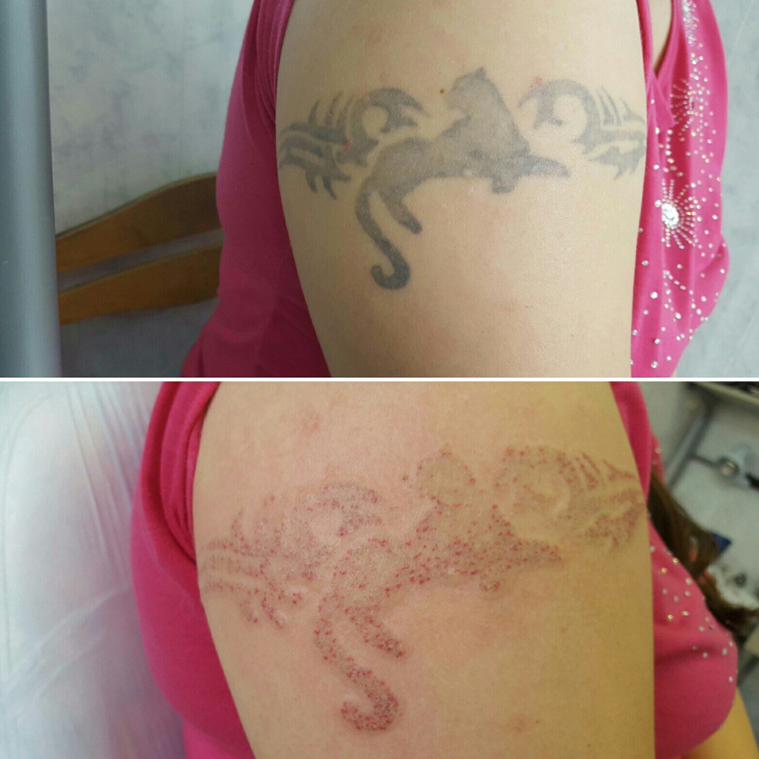 остаются ли шрамы после удаления татуировки лазером