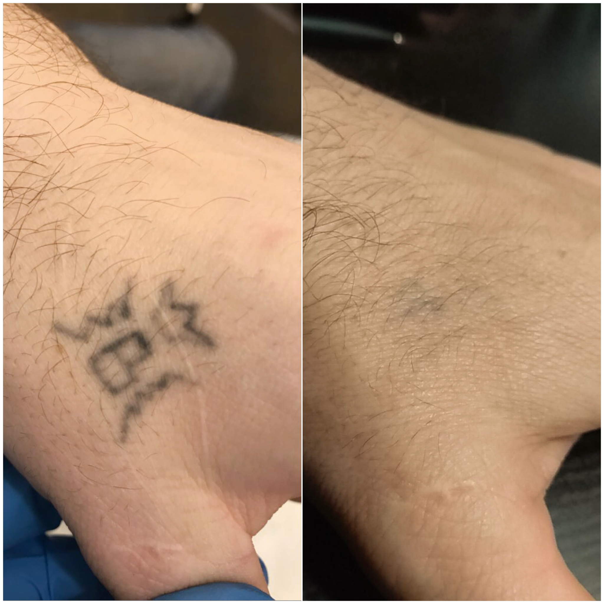 Лазерное удаление татуировки QS- лазером
