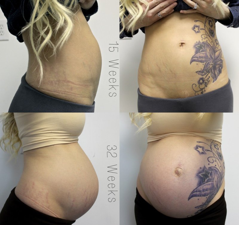 Татуировки, беременность и кормление грудью: ответы на сложные вопросы об опасности татуировок